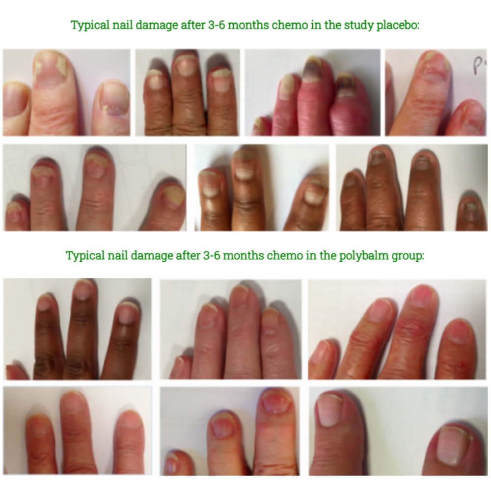 Polybalm Nail Remedy - Chemotherapy Damaged Nails